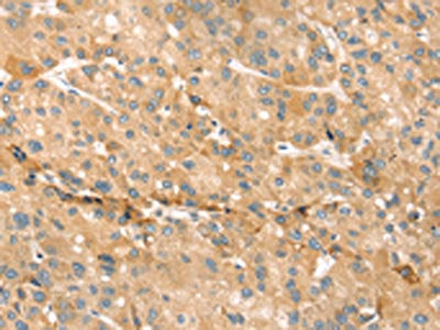 The image on the left is immunohistochemistry of paraffin-embedded Human liver cancer tissue using CSB-PA222058(EVA1A Antibody) at dilution 1/30, on the right is treated with synthetic peptide. (Original magnification: ×200)