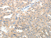 The image on the left is immunohistochemistry of paraffin-embedded Human ovarian cancer tissue using CSB-PA222144(LRP12 Antibody) at dilution 1/20, on the right is treated with fusion protein. (Original magnification: ×200)