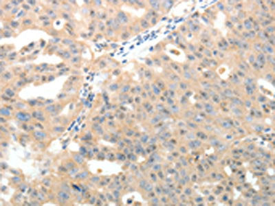 The image on the left is immunohistochemistry of paraffin-embedded Human ovarian cancer tissue using CSB-PA222144(LRP12 Antibody) at dilution 1/20, on the right is treated with fusion protein. (Original magnification: ×200)