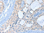 The image on the left is immunohistochemistry of paraffin-embedded Human cervical cancer tissue using CSB-PA223011(ANKRD54 Antibody) at dilution 1/40, on the right is treated with fusion protein. (Original magnification: ×200)