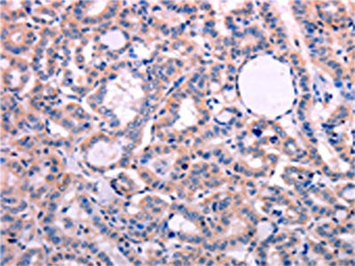The image on the left is immunohistochemistry of paraffin-embedded Human thyroid cancer tissue using CSB-PA223042(LEP Antibody) at dilution 1/30, on the right is treated with fusion protein. (Original magnification: ×200)