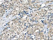The image on the left is immunohistochemistry of paraffin-embedded Human breast cancer tissue using CSB-PA223153(THAP4 Antibody) at dilution 1/20, on the right is treated with fusion protein. (Original magnification: ×200)