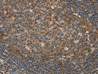The image on the left is immunohistochemistry of paraffin-embedded Human tonsil tissue using CSB-PA223262(CAMK4 Antibody) at dilution 1/20, on the right is treated with fusion protein. (Original magnification: ×200)
