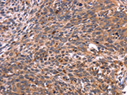 The image on the left is immunohistochemistry of paraffin-embedded Human cervical cancer tissue using CSB-PA223350(CRK Antibody) at dilution 1/40, on the right is treated with fusion protein. (Original magnification: ×200)