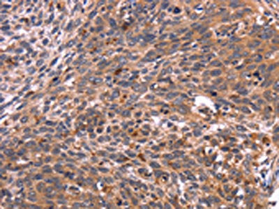 The image on the left is immunohistochemistry of paraffin-embedded Human cervical cancer tissue using CSB-PA223350(CRK Antibody) at dilution 1/40, on the right is treated with fusion protein. (Original magnification: ×200)