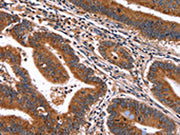 The image on the left is immunohistochemistry of paraffin-embedded Human colon cancer tissue using CSB-PA223356(HACE1 Antibody) at dilution 1/50, on the right is treated with synthetic peptide. (Original magnification: ×200)