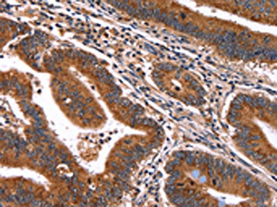 The image on the left is immunohistochemistry of paraffin-embedded Human colon cancer tissue using CSB-PA223356(HACE1 Antibody) at dilution 1/50, on the right is treated with synthetic peptide. (Original magnification: ×200)