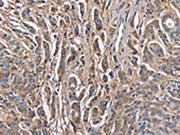 The image on the left is immunohistochemistry of paraffin-embedded Human prostate cancer tissue using CSB-PA223414(ABI3BP Antibody) at dilution 1/60, on the right is treated with fusion protein. (Original magnification: ×200)