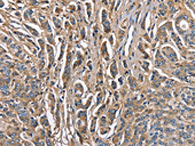 The image on the left is immunohistochemistry of paraffin-embedded Human prostate cancer tissue using CSB-PA223414(ABI3BP Antibody) at dilution 1/60, on the right is treated with fusion protein. (Original magnification: ×200)
