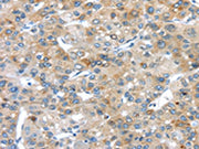 The image on the left is immunohistochemistry of paraffin-embedded Human liver cancer tissue using CSB-PA223469(PLXNA3 Antibody) at dilution 1/20, on the right is treated with synthetic peptide. (Original magnification: ×200)