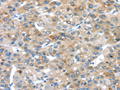 The image on the left is immunohistochemistry of paraffin-embedded Human liver cancer tissue using CSB-PA223469(PLXNA3 Antibody) at dilution 1/20, on the right is treated with synthetic peptide. (Original magnification: ×200)