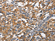 The image on the left is immunohistochemistry of paraffin-embedded Human thyroid cancer tissue using CSB-PA223476(DDR2 Antibody) at dilution 1/40, on the right is treated with synthetic peptide. (Original magnification: ×200)