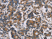 The image on the left is immunohistochemistry of paraffin-embedded Human colon cancer tissue using CSB-PA223569(MRPL39 Antibody) at dilution 1/30, on the right is treated with fusion protein. (Original magnification: ×200)
