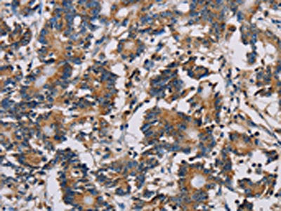 The image on the left is immunohistochemistry of paraffin-embedded Human colon cancer tissue using CSB-PA223569(MRPL39 Antibody) at dilution 1/30, on the right is treated with fusion protein. (Original magnification: ×200)