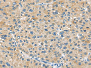 The image on the left is immunohistochemistry of paraffin-embedded Human liver cancer tissue using CSB-PA223592(ABCC2 Antibody) at dilution 1/45, on the right is treated with synthetic peptide. (Original magnification: ×200)