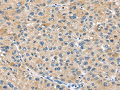 The image on the left is immunohistochemistry of paraffin-embedded Human liver cancer tissue using CSB-PA223592(ABCC2 Antibody) at dilution 1/45, on the right is treated with synthetic peptide. (Original magnification: ×200)