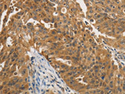 The image on the left is immunohistochemistry of paraffin-embedded Human ovarian cancer tissue using CSB-PA223710(PTPN11 Antibody) at dilution 1/25, on the right is treated with fusion protein. (Original magnification: ×200)