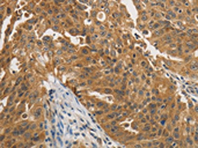 The image on the left is immunohistochemistry of paraffin-embedded Human ovarian cancer tissue using CSB-PA223710(PTPN11 Antibody) at dilution 1/25, on the right is treated with fusion protein. (Original magnification: ×200)