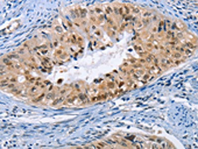 The image on the left is immunohistochemistry of paraffin-embedded Human cervical cancer tissue using CSB-PA223753(BAG1 Antibody) at dilution 1/20, on the right is treated with fusion protein. (Original magnification: ×200)