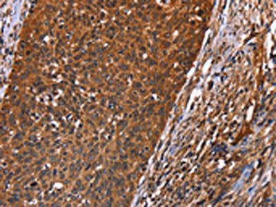 The image on the left is immunohistochemistry of paraffin-embedded Human cervical cancer tissue using CSB-PA223860(GUK1 Antibody) at dilution 1/40, on the right is treated with synthetic peptide. (Original magnification: ×200)