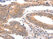 The image on the left is immunohistochemistry of paraffin-embedded Human colon cancer tissue using CSB-PA223916(SEMA3G Antibody) at dilution 1/30, on the right is treated with fusion protein. (Original magnification: ×200)