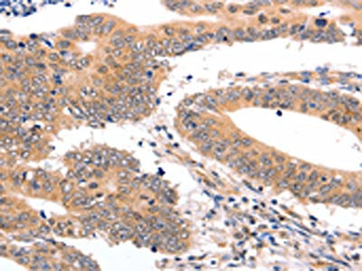 The image on the left is immunohistochemistry of paraffin-embedded Human colon cancer tissue using CSB-PA223916(SEMA3G Antibody) at dilution 1/30, on the right is treated with fusion protein. (Original magnification: ×200)