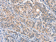 The image on the left is immunohistochemistry of paraffin-embedded Human gastic cancer tissue using CSB-PA223936(ELOVL6 Antibody) at dilution 1/40, on the right is treated with synthetic peptide. (Original magnification: ×200)