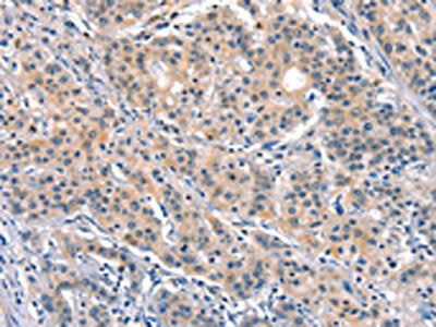 The image on the left is immunohistochemistry of paraffin-embedded Human gastic cancer tissue using CSB-PA223936(ELOVL6 Antibody) at dilution 1/40, on the right is treated with synthetic peptide. (Original magnification: ×200)