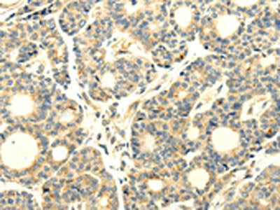The image on the left is immunohistochemistry of paraffin-embedded Human thyroid cancer tissue using CSB-PA223941(WDR91 Antibody) at dilution 1/20, on the right is treated with synthetic peptide. (Original magnification: ×200)