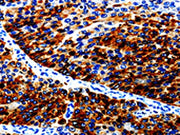 The image on the left is immunohistochemistry of paraffin-embedded Human renal cancer tissue using CSB-PA224008(AGR2 Antibody) at dilution 1/10, on the right is treated with fusion protein. (Original magnification: ×200)