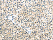 The image on the left is immunohistochemistry of paraffin-embedded Human breast cancer tissue using CSB-PA224049(TTBK2 Antibody) at dilution 1/45, on the right is treated with synthetic peptide. (Original magnification: ×200)
