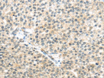 The image on the left is immunohistochemistry of paraffin-embedded Human breast cancer tissue using CSB-PA224049(TTBK2 Antibody) at dilution 1/45, on the right is treated with synthetic peptide. (Original magnification: ×200)