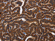 The image on the left is immunohistochemistry of paraffin-embedded Human thyroid cancer tissue using CSB-PA224064(TICAM2 Antibody) at dilution 1/60, on the right is treated with fusion protein. (Original magnification: ×200)