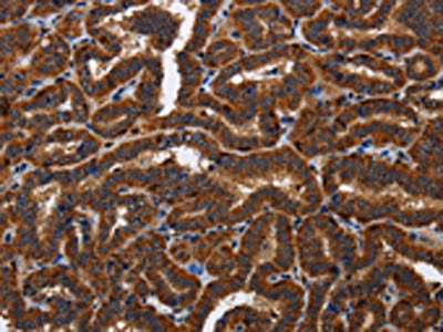 The image on the left is immunohistochemistry of paraffin-embedded Human thyroid cancer tissue using CSB-PA224064(TICAM2 Antibody) at dilution 1/60, on the right is treated with fusion protein. (Original magnification: ×200)
