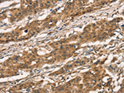 The image on the left is immunohistochemistry of paraffin-embedded Human gastic cancer tissue using CSB-PA224134(CXCR6 Antibody) at dilution 1/30, on the right is treated with fusion protein. (Original magnification: ×200)