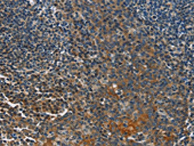 The image on the left is immunohistochemistry of paraffin-embedded Human tonsil tissue using CSB-PA224156(CACNB1 Antibody) at dilution 1/50, on the right is treated with fusion protein. (Original magnification: ×200)