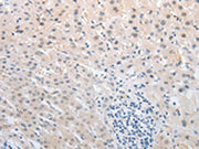 The image on the left is immunohistochemistry of paraffin-embedded Human liver cancer tissue using CSB-PA224370(NFAT5 Antibody) at dilution 1/25, on the right is treated with synthetic peptide. (Original magnification: ×200)