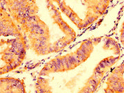 IHC image of CSB-PA22439A0Rb diluted at 1:500 and staining in paraffin-embedded human endometrial cancer performed on a Leica BondTM system. After dewaxing and hydration, antigen retrieval was mediated by high pressure in a citrate buffer (pH 6.0)...