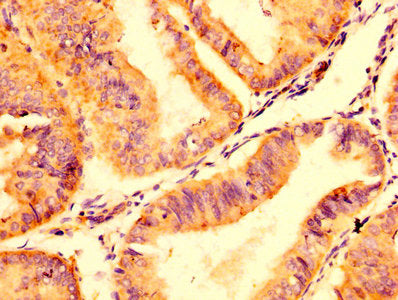 IHC image of CSB-PA22439A0Rb diluted at 1:500 and staining in paraffin-embedded human endometrial cancer performed on a Leica BondTM system. After dewaxing and hydration, antigen retrieval was mediated by high pressure in a citrate buffer (pH 6.0)...