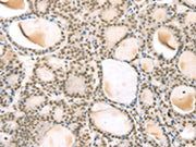 The image on the left is immunohistochemistry of paraffin-embedded Human thyroid cancer tissue using CSB-PA224565(TSPAN13 Antibody) at dilution 1/35, on the right is treated with synthetic peptide. (Original magnification: ×200)
