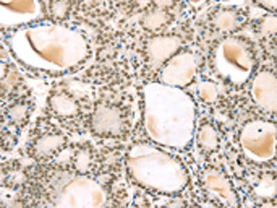 The image on the left is immunohistochemistry of paraffin-embedded Human thyroid cancer tissue using CSB-PA224565(TSPAN13 Antibody) at dilution 1/35, on the right is treated with synthetic peptide. (Original magnification: ×200)
