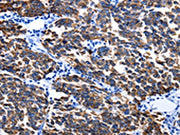 The image on the left is immunohistochemistry of paraffin-embedded Human breast cancer tissue using CSB-PA224586(KRT6A Antibody) at dilution 1/25, on the right is treated with fusion protein. (Original magnification: ×200)