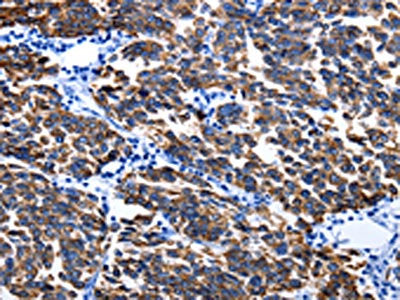 The image on the left is immunohistochemistry of paraffin-embedded Human breast cancer tissue using CSB-PA224586(KRT6A Antibody) at dilution 1/25, on the right is treated with fusion protein. (Original magnification: ×200)