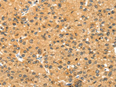 The image on the left is immunohistochemistry of paraffin-embedded Human liver cancer tissue using CSB-PA224595(SMYD3 Antibody) at dilution 1/30, on the right is treated with fusion protein. (Original magnification: ×200)