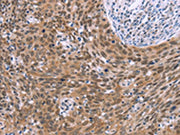 The image on the left is immunohistochemistry of paraffin-embedded Human cervical cancer tissue using CSB-PA224597(GLYR1 Antibody) at dilution 1/30, on the right is treated with synthetic peptide. (Original magnification: ×200)