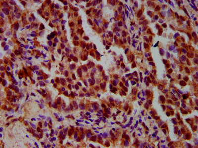 IHC image of CSB-PA22459A0Rb diluted at 1:600 and staining in paraffin-embedded human lung cancer performed on a Leica BondTM system. After dewaxing and hydration, antigen retrieval was mediated by high pressure in a citrate buffer (pH 6.0). Secti...