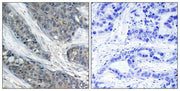 Immunohistochemical analysis of paraffin-embedded human breast carcinoma tissue, using IRS-1 (phospho-Ser307) antibody.