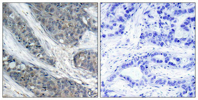 Immunohistochemical analysis of paraffin-embedded human breast carcinoma tissue, using IRS-1 (phospho-Ser307) antibody.