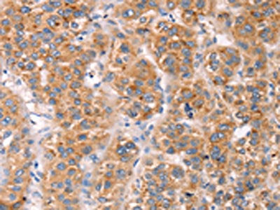 The image on the left is immunohistochemistry of paraffin-embedded Human liver cancer tissue using CSB-PA224944(MLNR Antibody) at dilution 1/45, on the right is treated with synthetic peptide. (Original magnification: ×200)