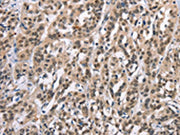 The image on the left is immunohistochemistry of paraffin-embedded Human esophagus cancer tissue using CSB-PA225115(ADNP Antibody) at dilution 1/15, on the right is treated with synthetic peptide. (Original magnification: ×200)
